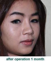 plastic_surgery_augmentation_rhinoplasty